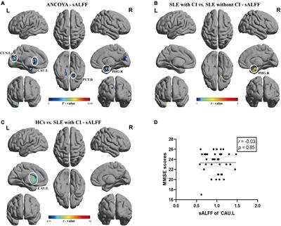 Dynamic changes of amplitude of low-frequency in systemic lupus erythematosus patients with cognitive impairment